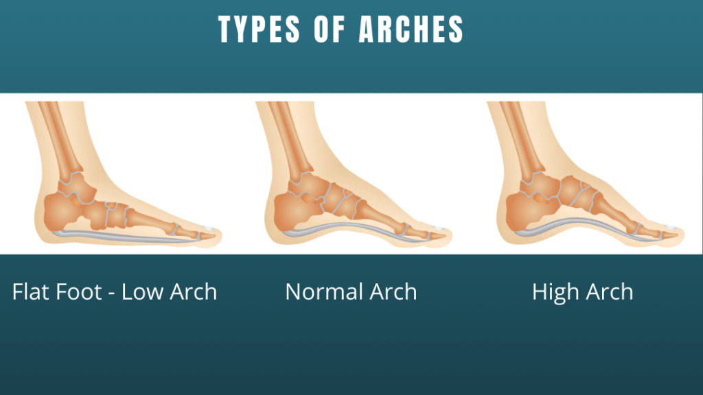 Difference between high arches, low arches, and neutral.